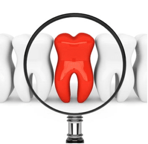 emergency root canal therapy