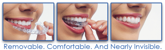 Invisalign