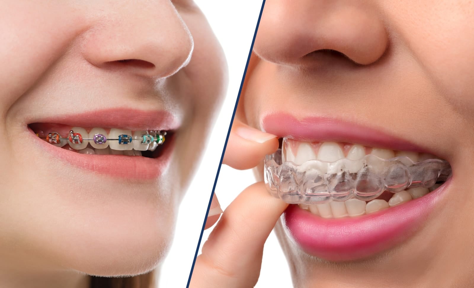 On the left are standard metal braces. On the right is a clear, effective Invisalign aligner.