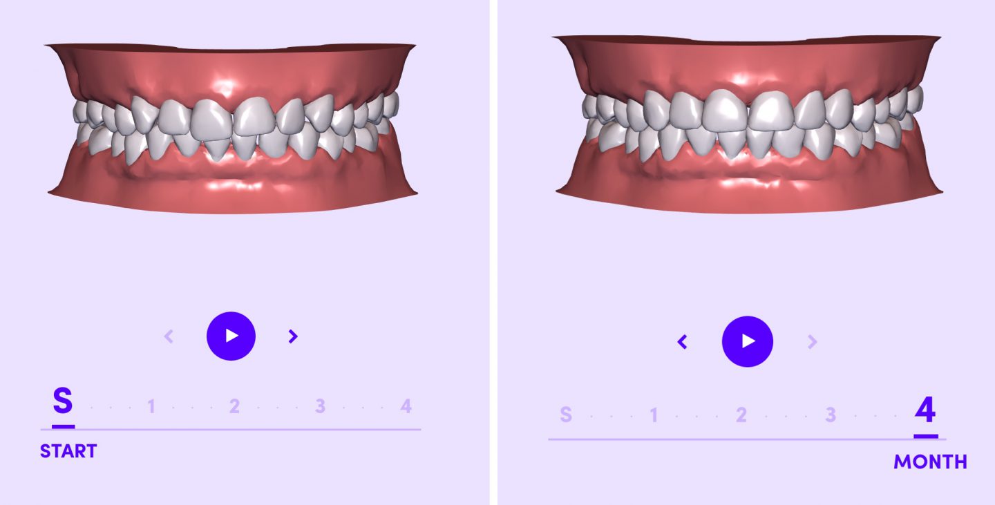 This photo is showing how each step in the Smile Direct Club process is done through the computer and shipped to your home.