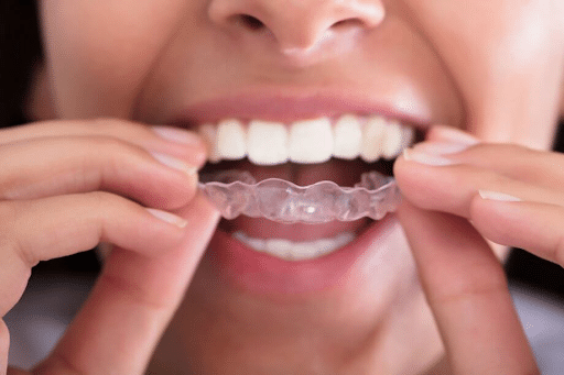 Invisalign