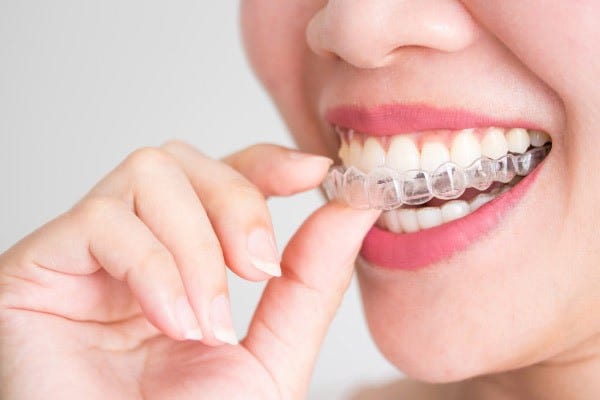 Choose Invisalign
