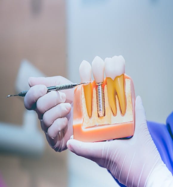 _What Are Dental Implants_