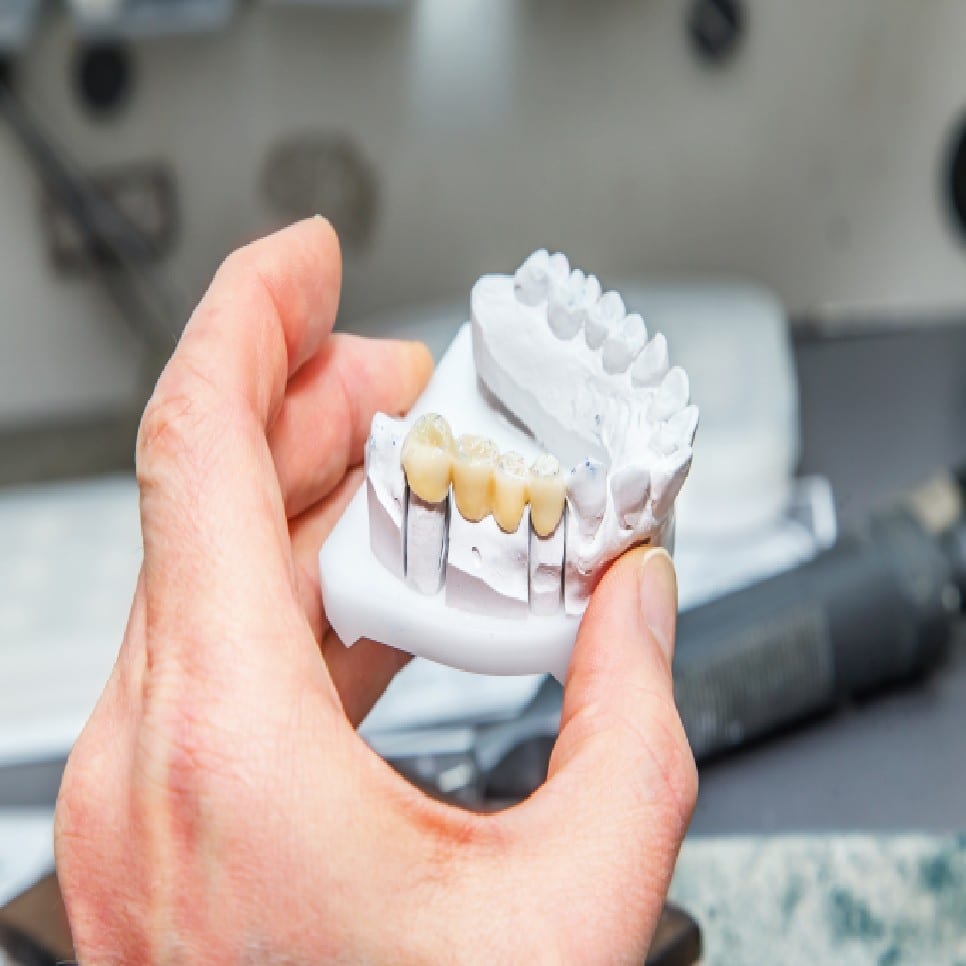 Dental Bridges In New York City
