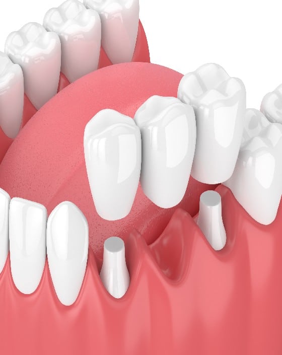 _What Is A Dental Bridge_