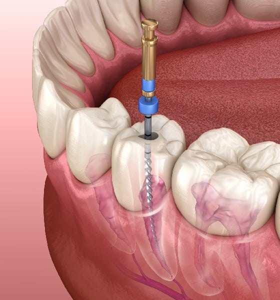 _What Is Endodontic Therapy_
