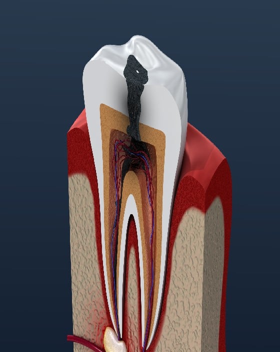 _What is Caries_