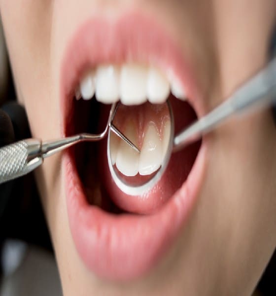 _What Is Gum Disease_