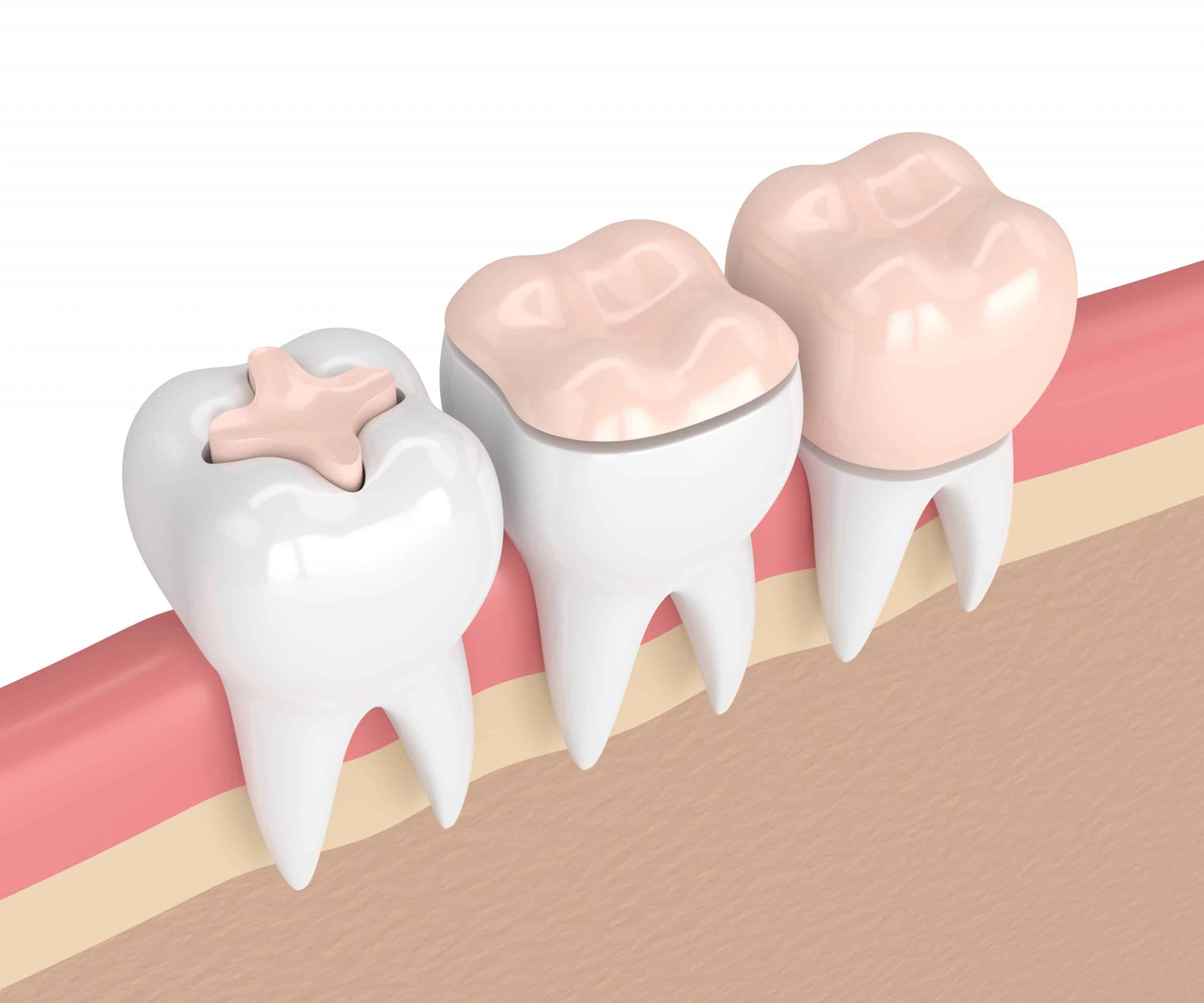 3d render of teeth with different types of dental filling
