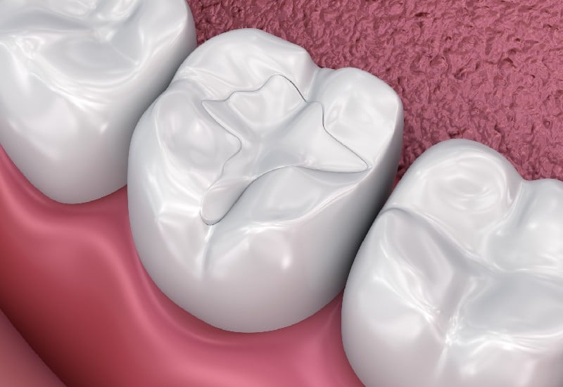 Types of Restorative Procedures