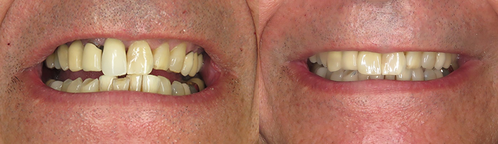 Dental Implants Case