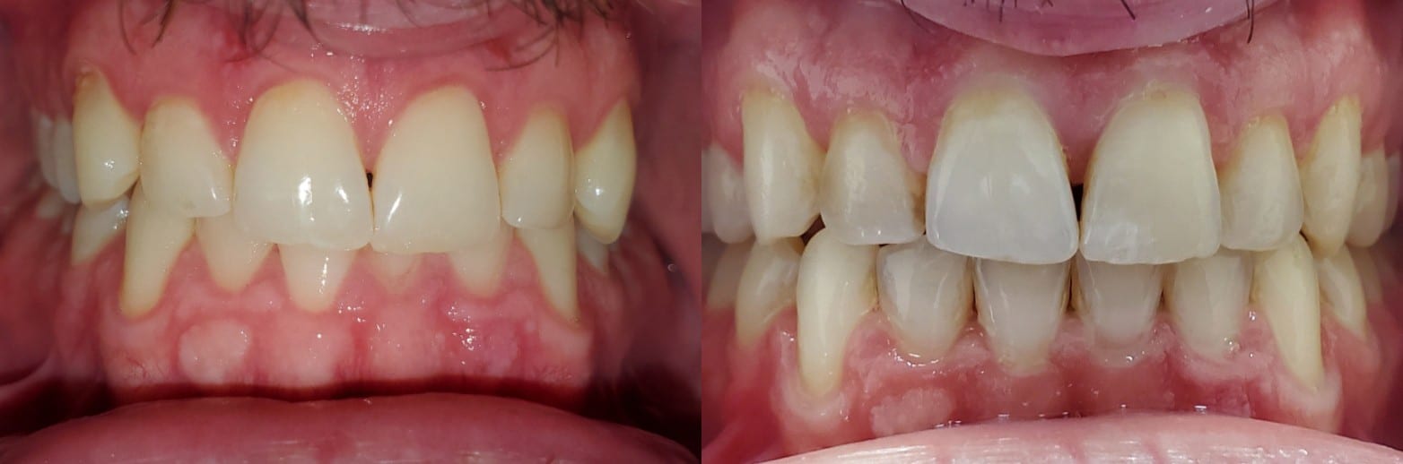 Invisalign Case 1