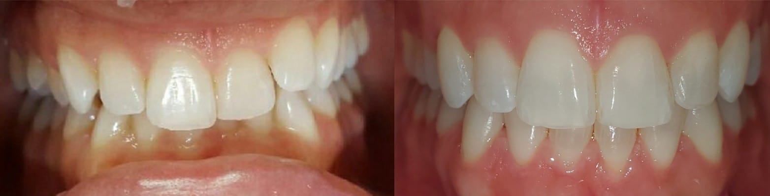 Invisalign Case 2