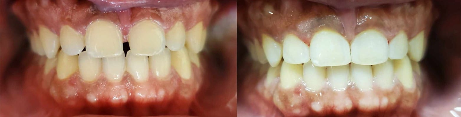 Invisalign Case 3
