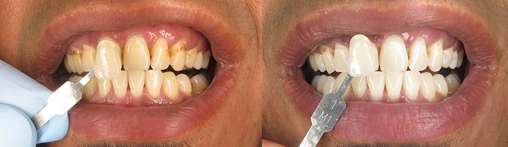 Whitening & Color Matching Case
