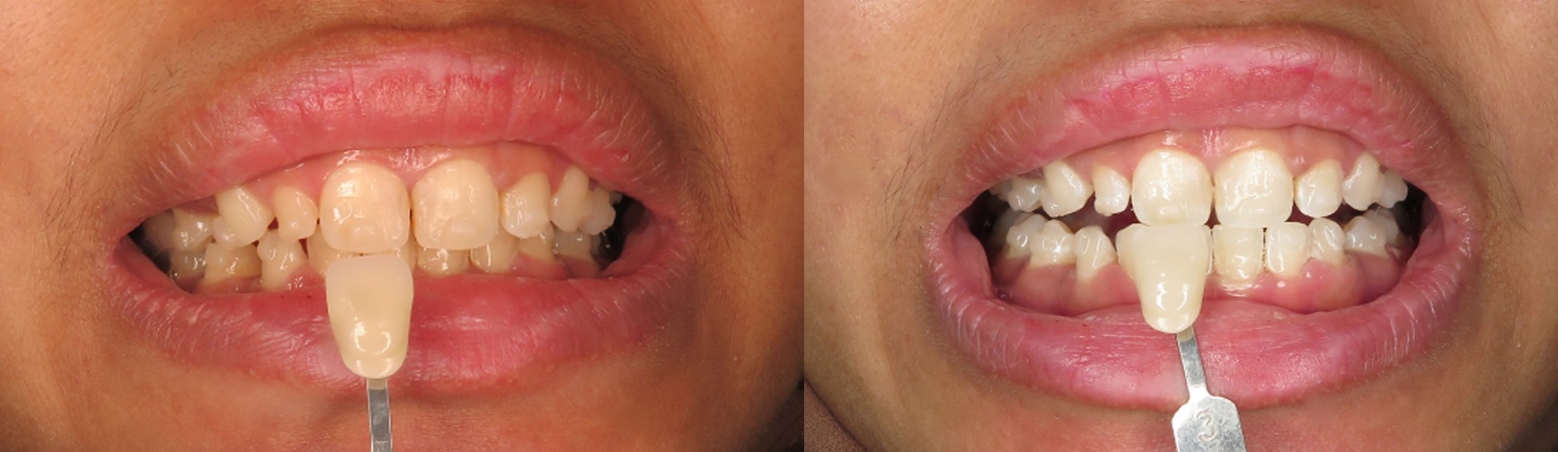 Color Matching & Whitening