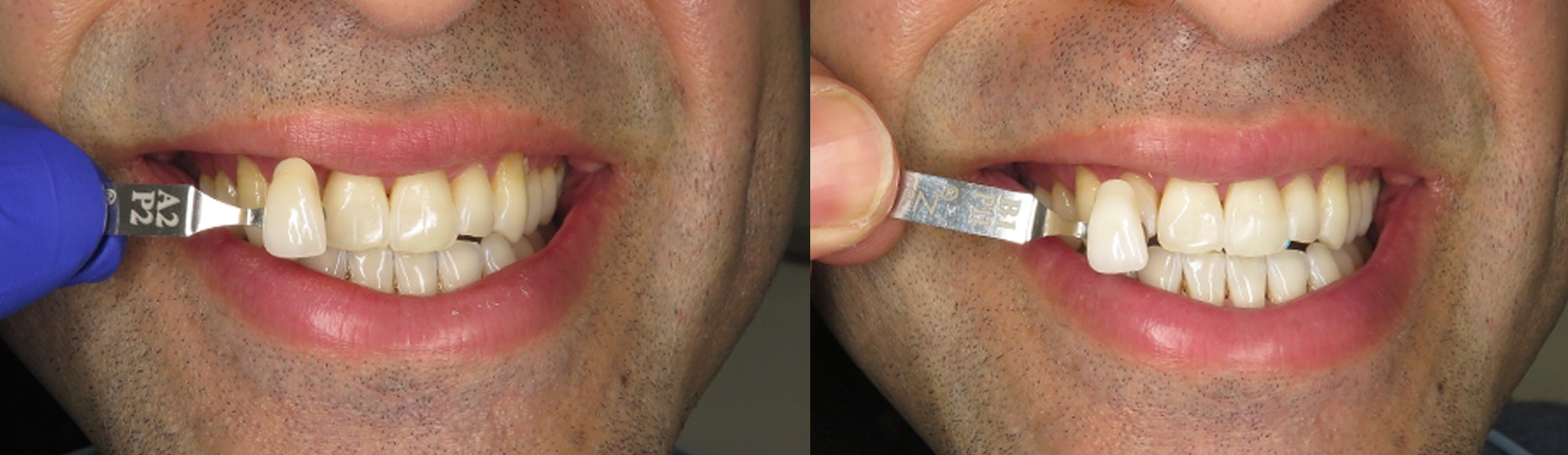 Color Matching & Whitening