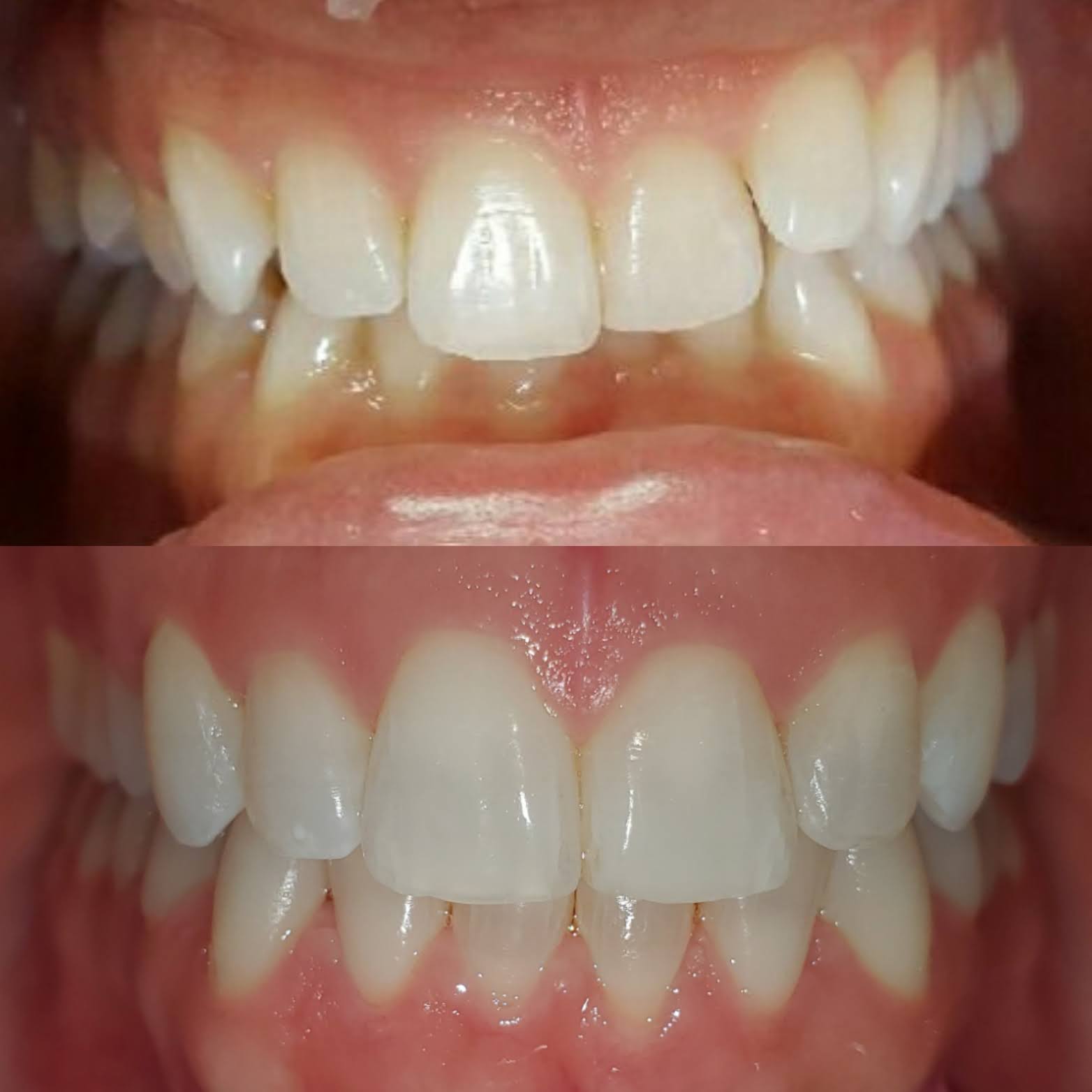 This is one of our Invisalign patients who sought treatment for their overbite 