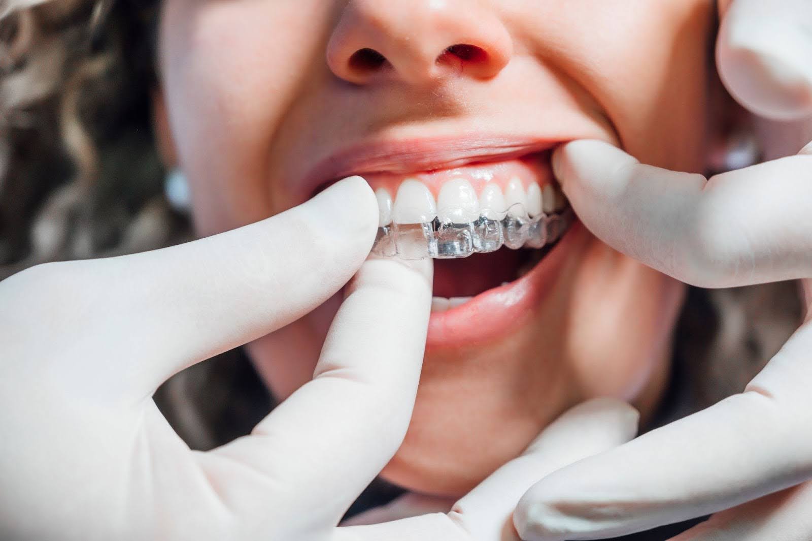 When it comes to correcting your overbite, there are several orthodontic treatment options to choose from.