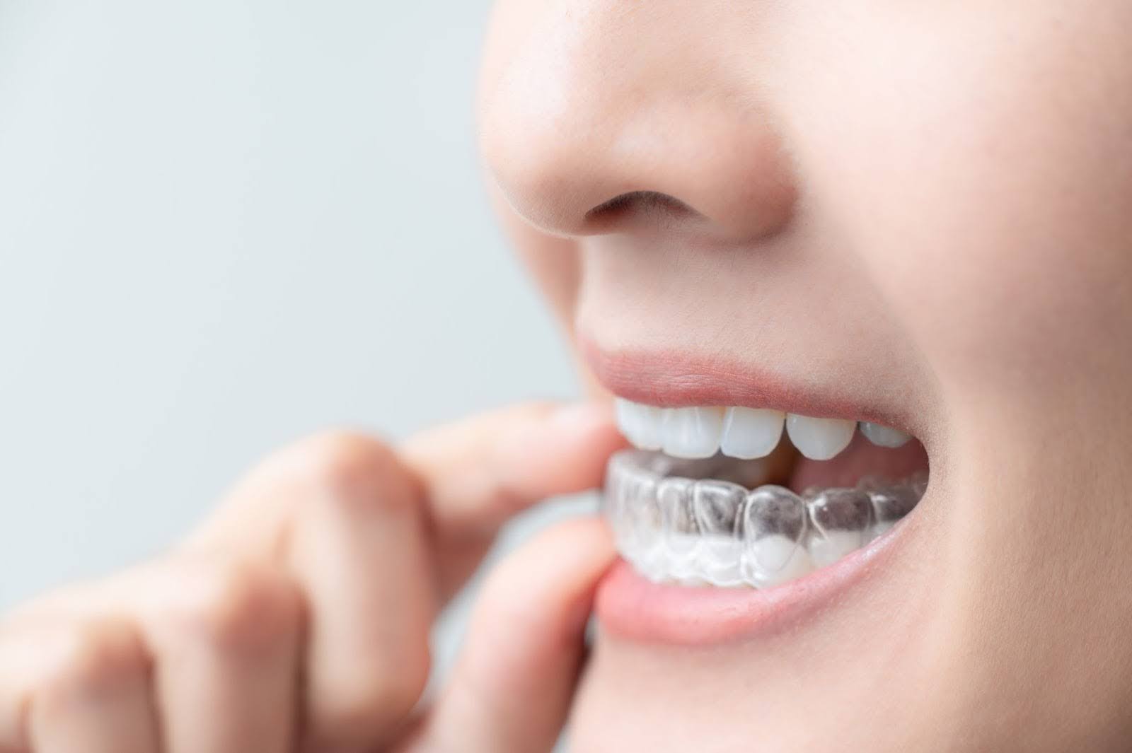 Invisalign overbite before-and-after images vividly illustrate the aesthetic and functional improvements achieved through Invisalign treatment for overbites.