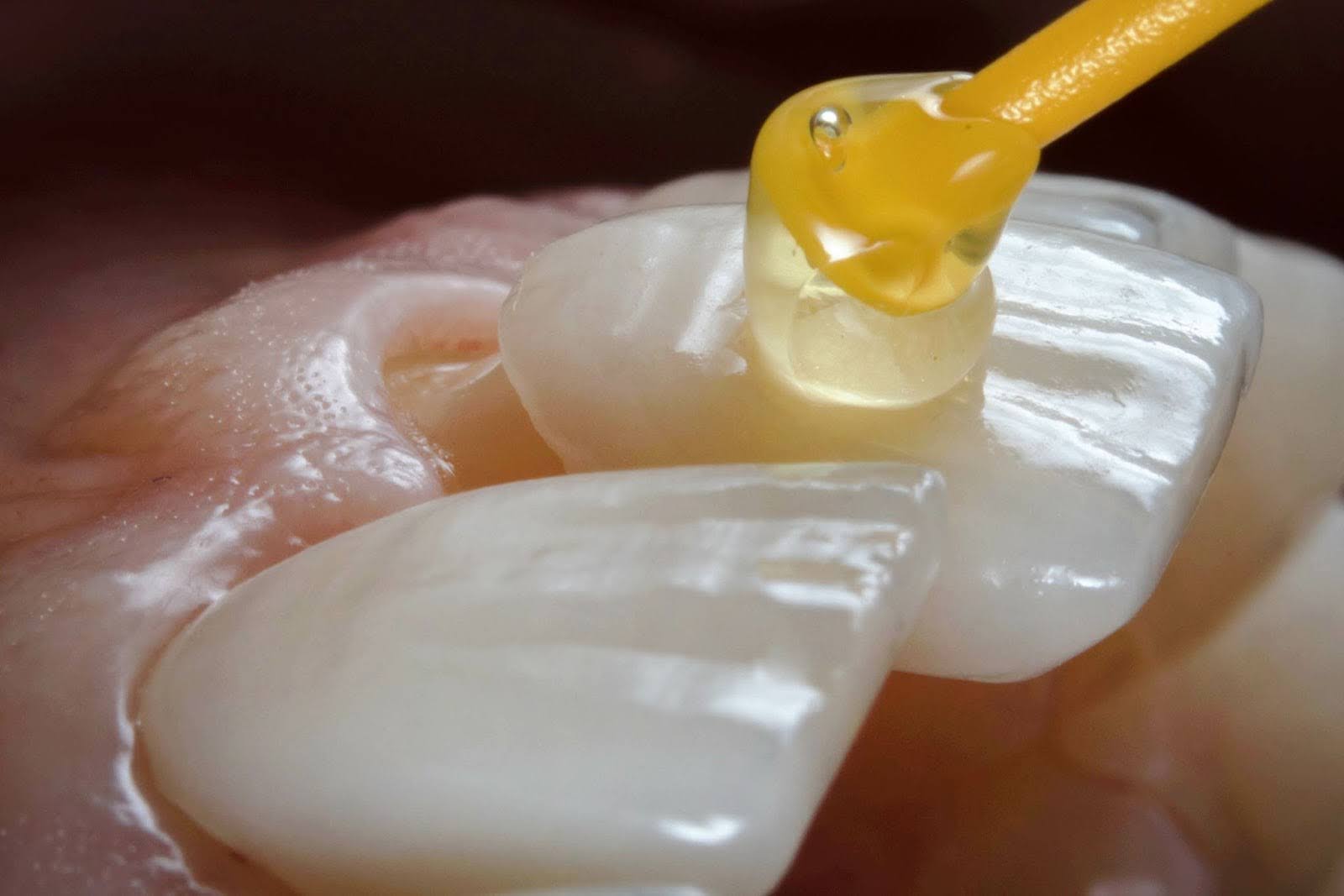 Transformative Smiles: Porcelain Veneers Before and After