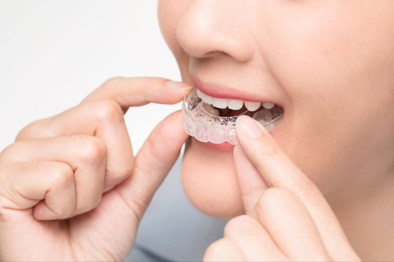Clear Retainers (Essix Retainers)