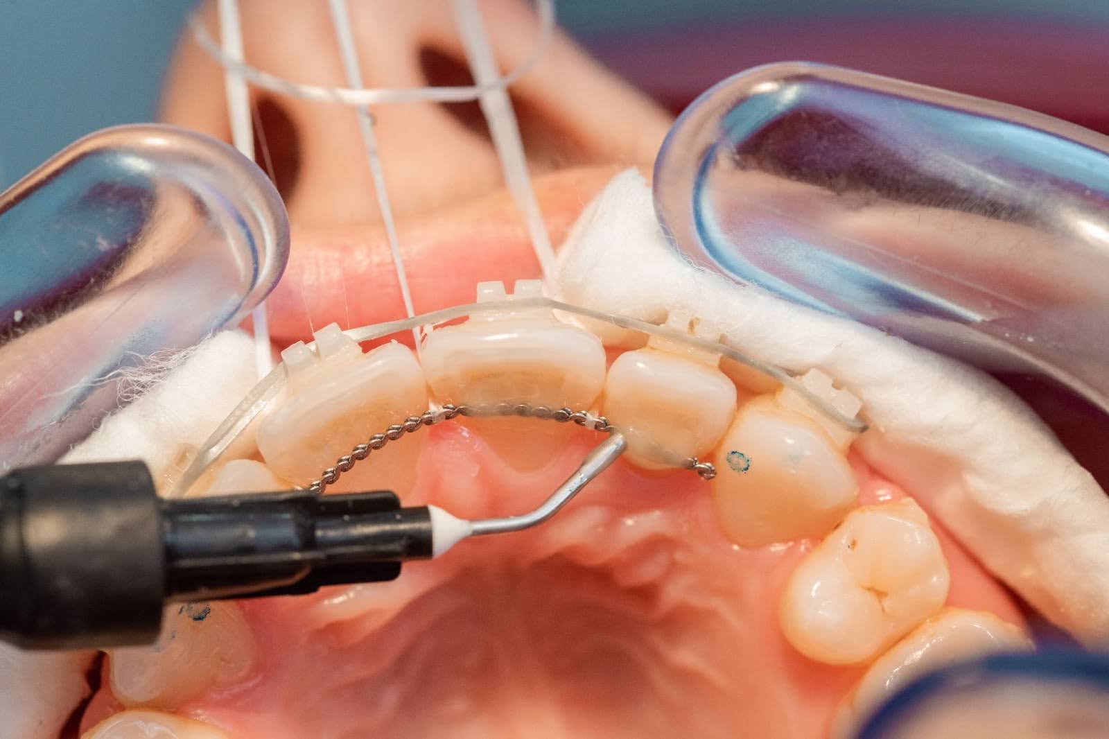 Fixed Retainers