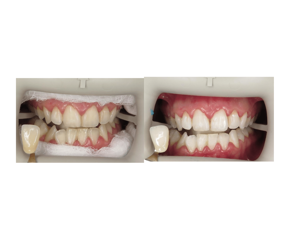 Before & After 1